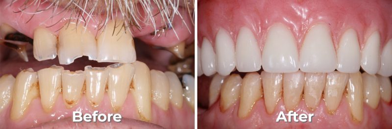 Implants Dentist in West Grove