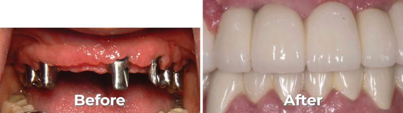 Implants Dentist in West Grove