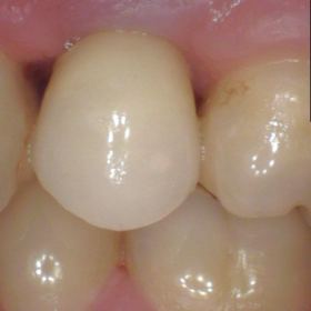 Implants Dentist in West Grove