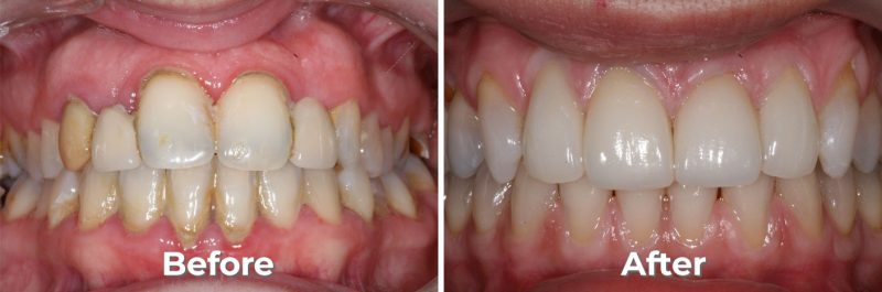 Metal Free Crowns in West Grove