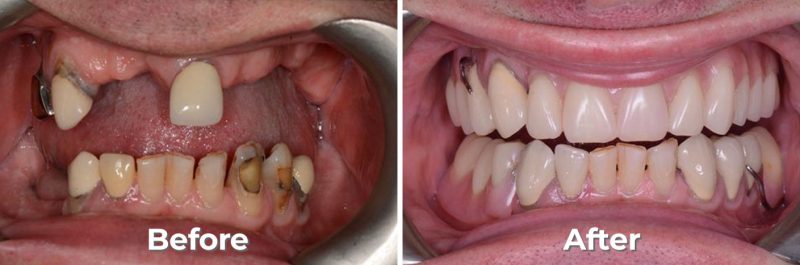 Removable Partials & Dentures in West Grove