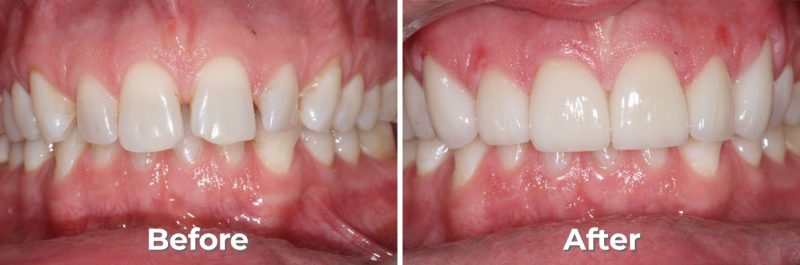 Porcelain Veneers in West Grove