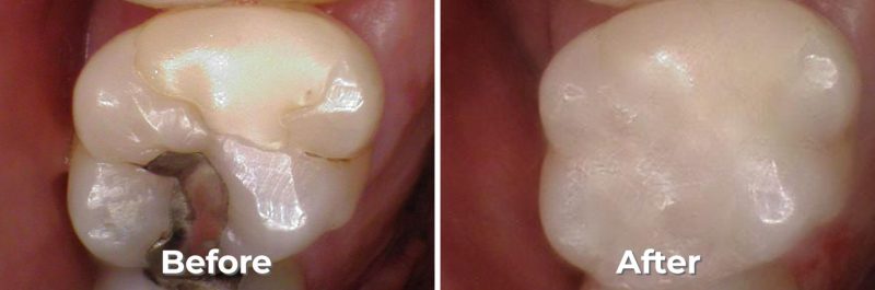 Tooth Colored Fillings in West Grove