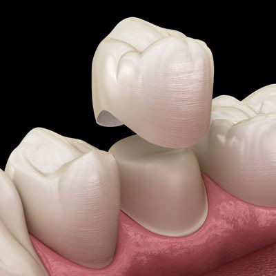 Root Canals in West Grove