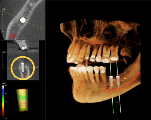 Implants Dentist in West Grove