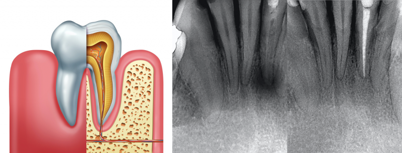 Root Canals in West Grove