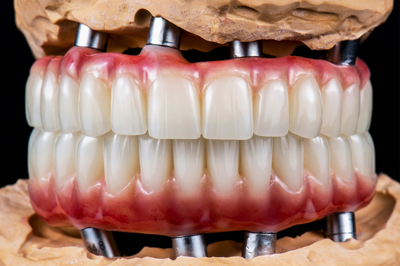 Full-Mouth Implants in San Luis Obispo