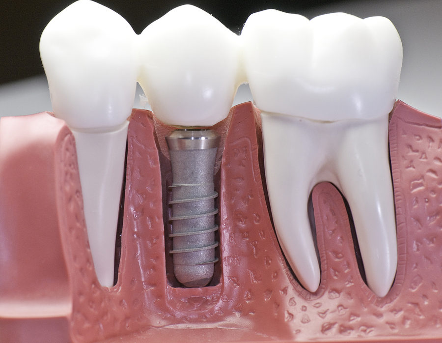 Implants Dentist in Littleton