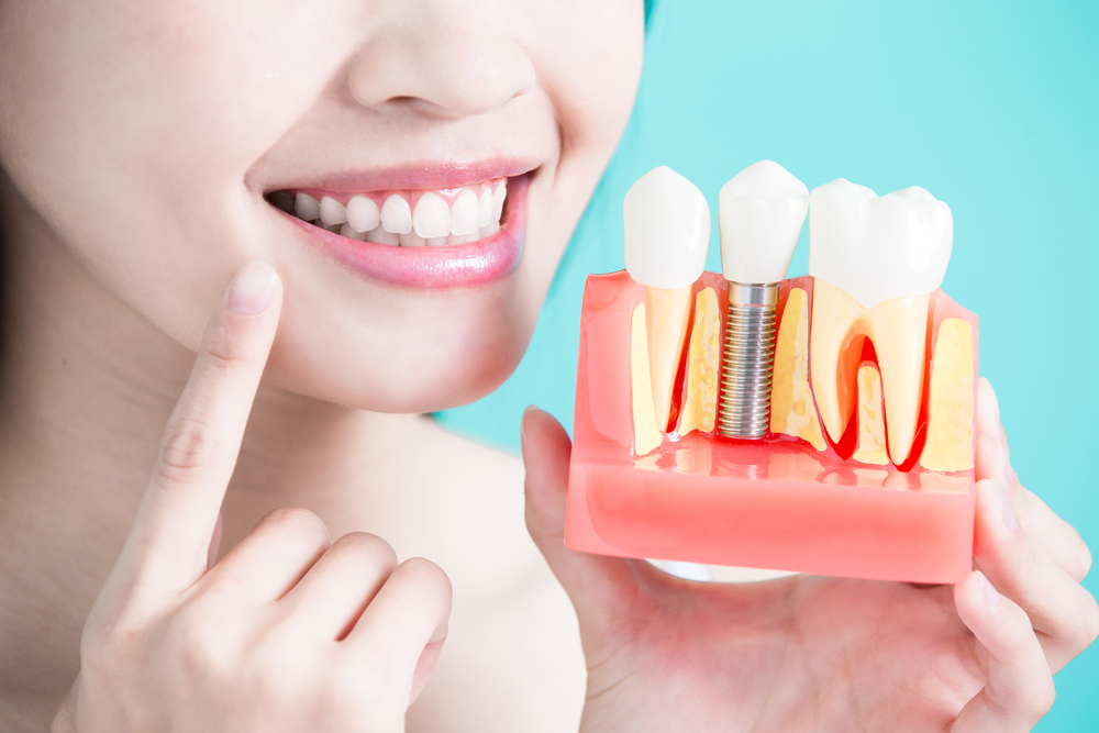 All on 4 Dental Implants in Littleton
