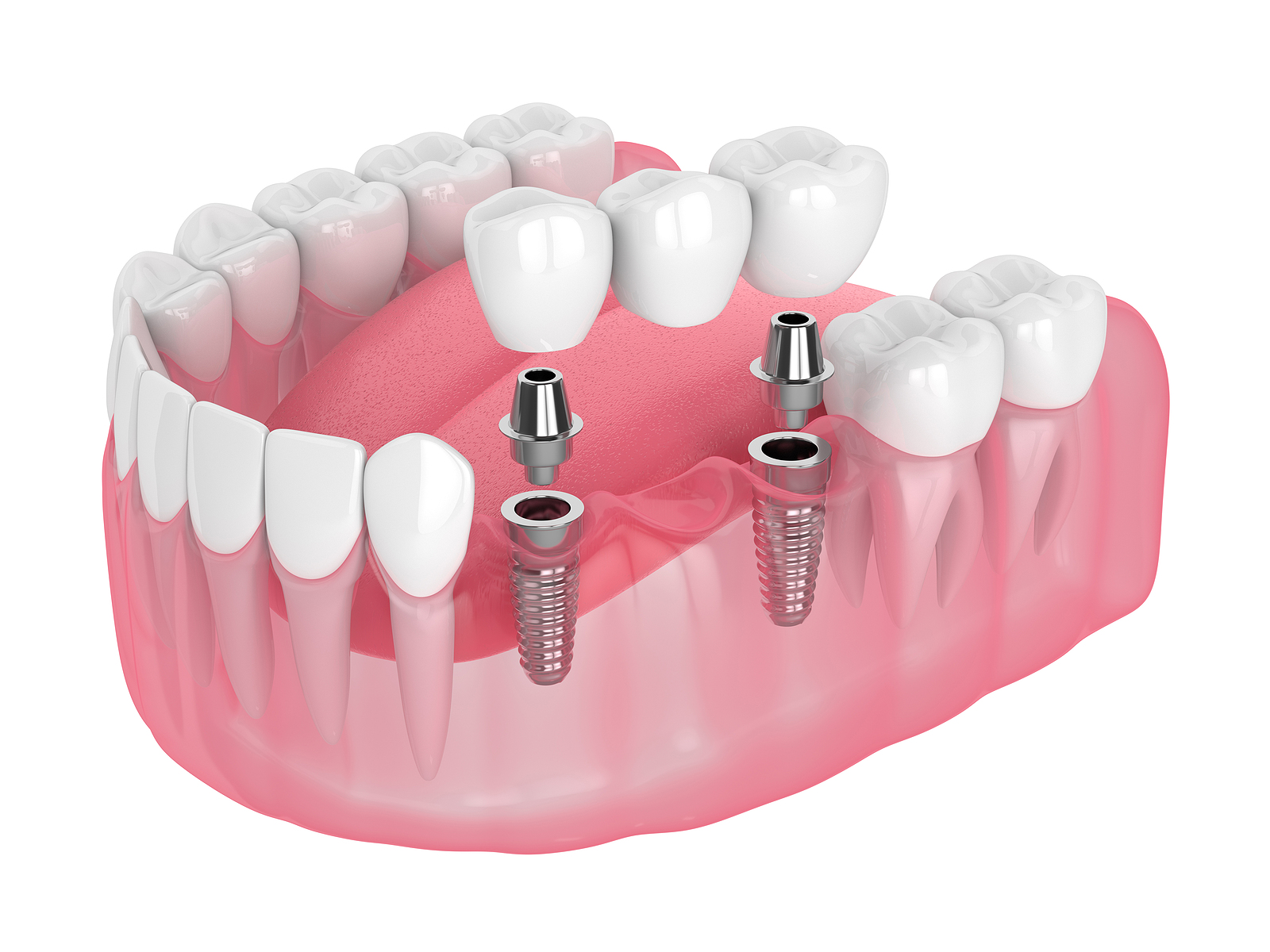 Implants Dentist in Littleton