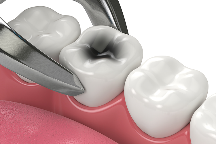 Tooth Extractions in Littleton