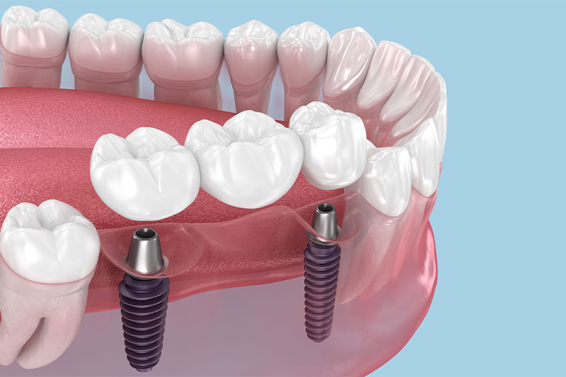 Westfield Dental Implants