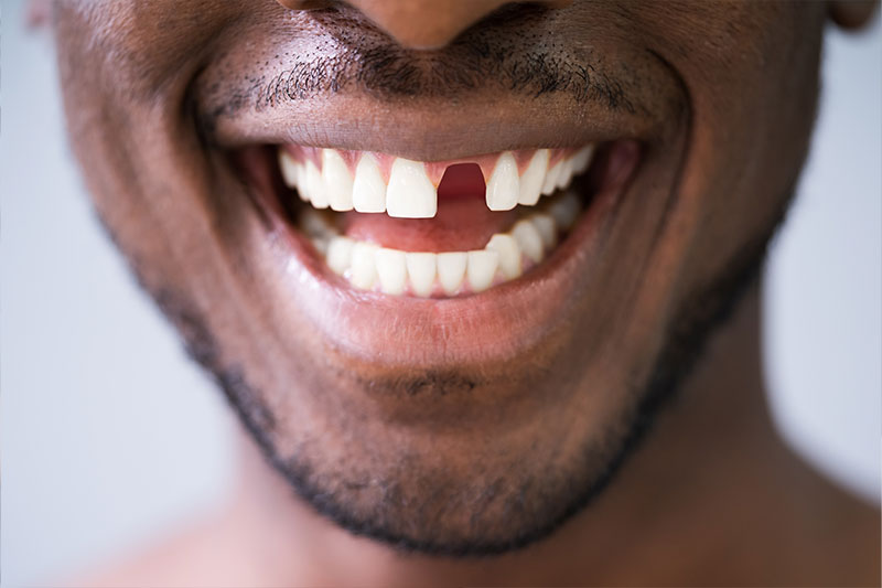 Tooth Replacement Westfield