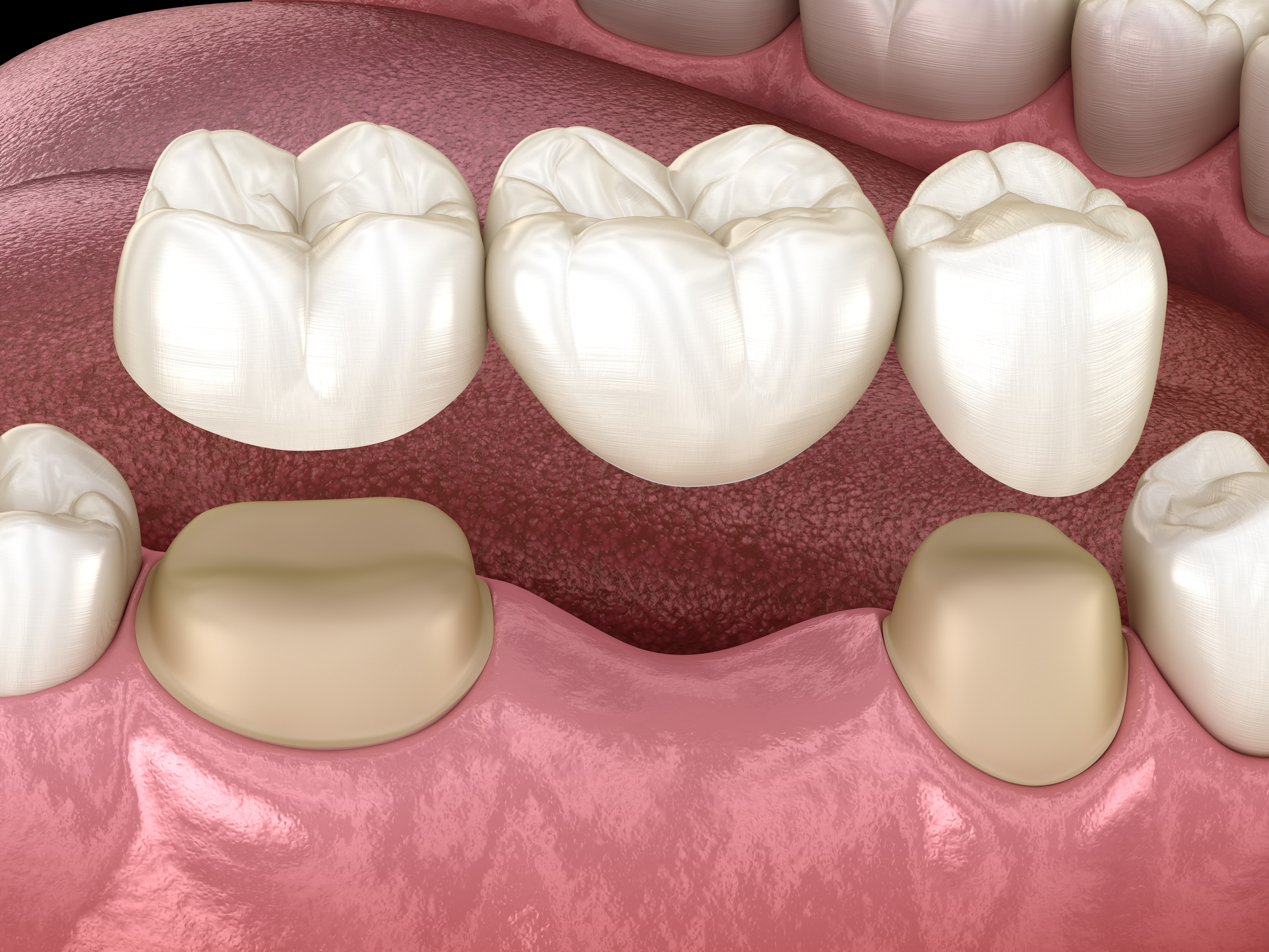 Dental Bridges in Salt Lake City