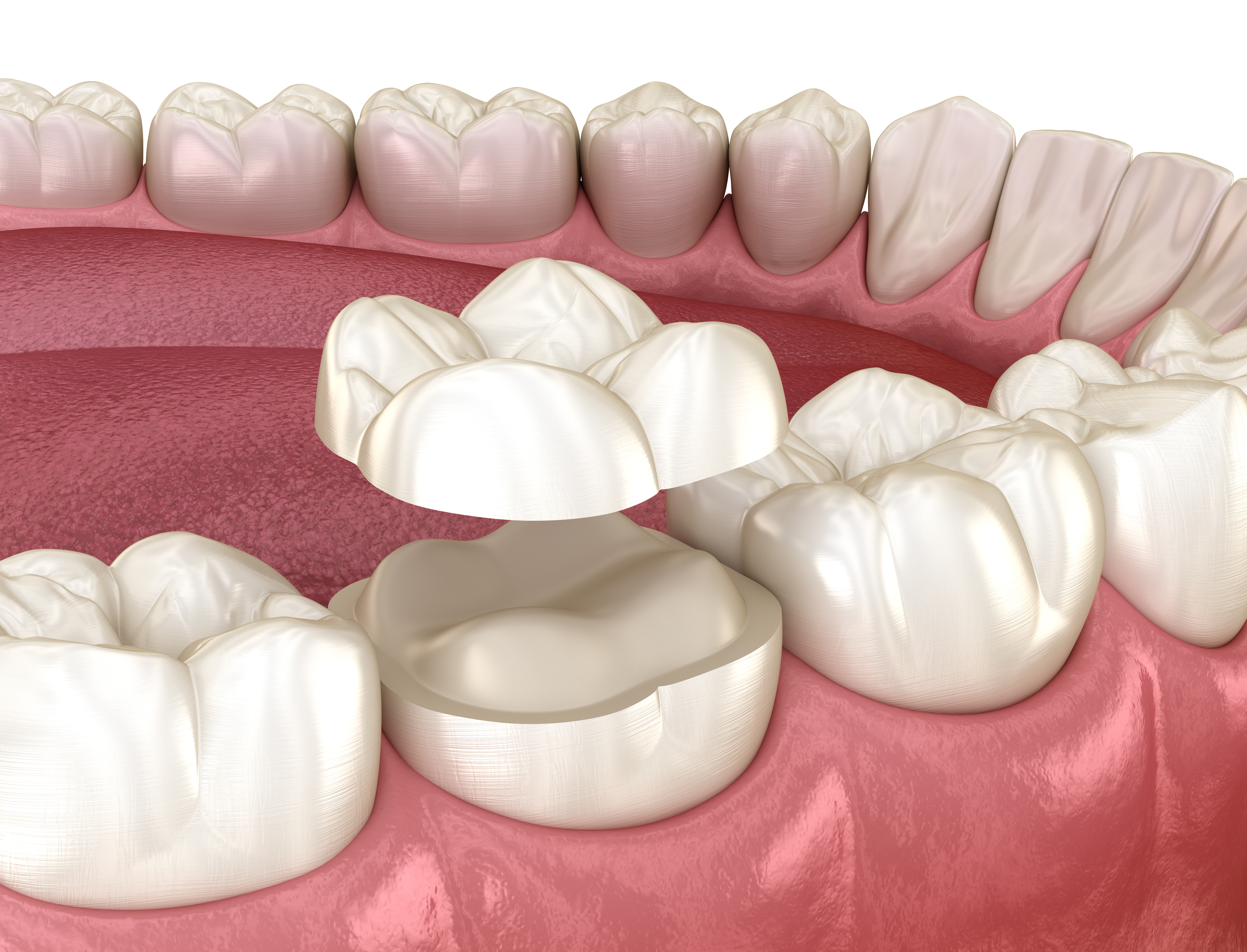 Dental Crowns in Salt Lake City