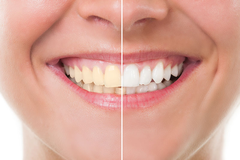 Teeth Whitening in Salt Lake City