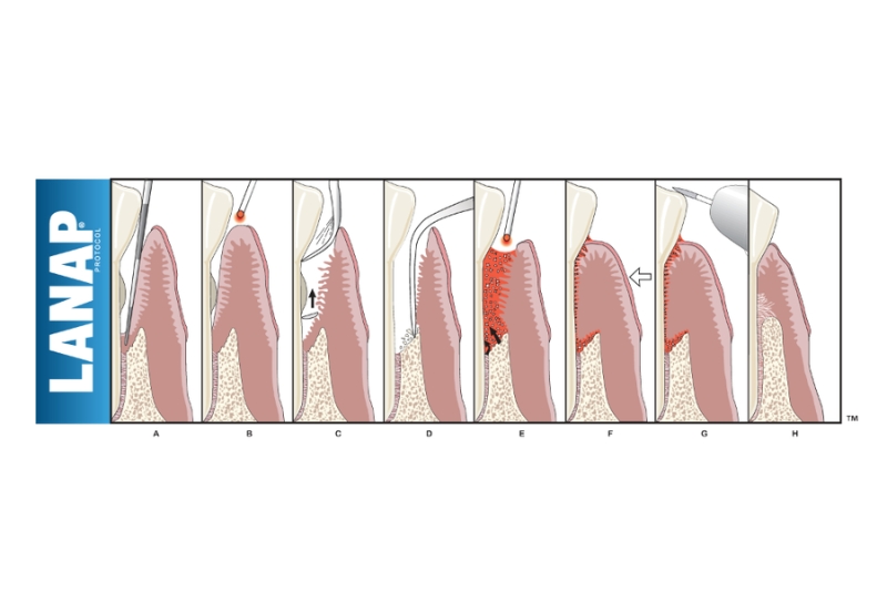 Laser Periodontal Therapy  in Temple City
