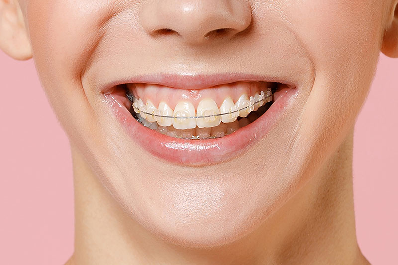 Clear Braces in Norcross