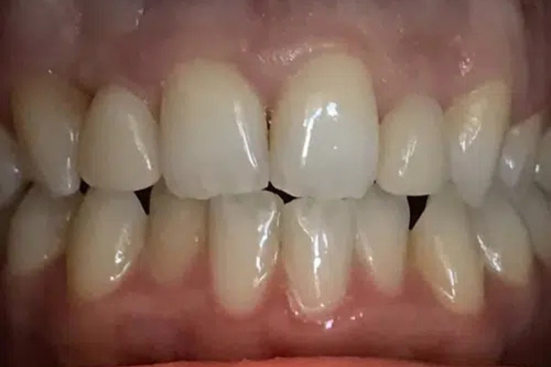 Same-Day Crowns - After