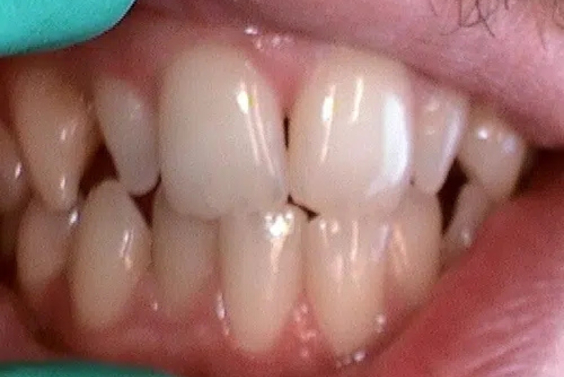 Same-Day Crowns - Before