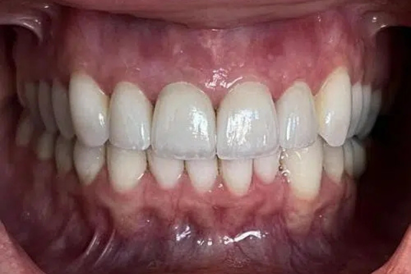 Cosmetic Dentistry - After