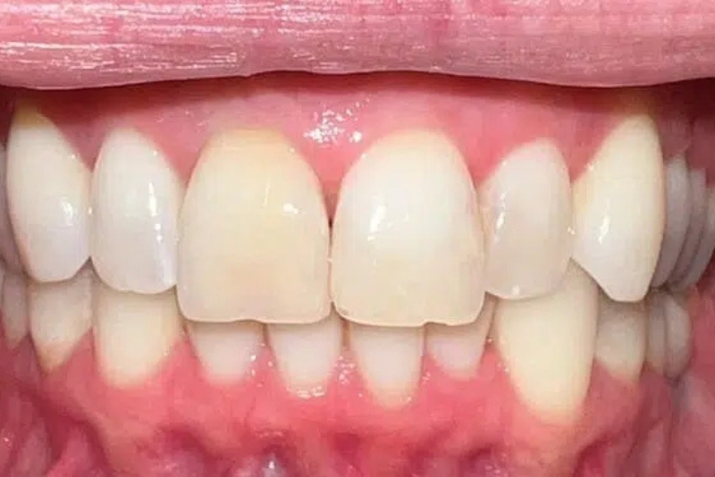 Cosmetic Dentistry - Before