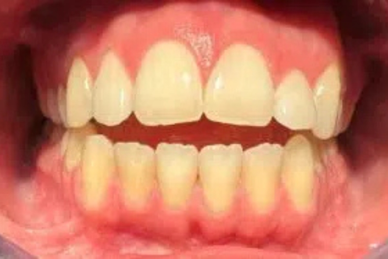Cosmetic Dentistry - Before