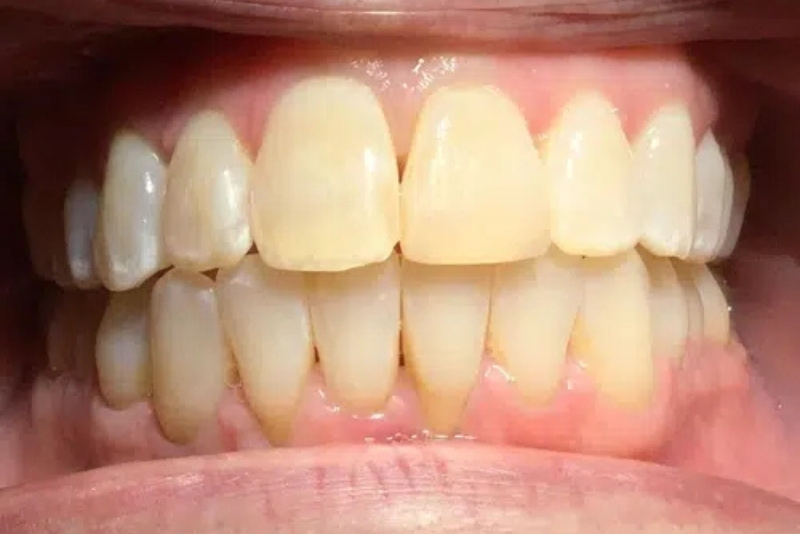 Clear Aligners - After