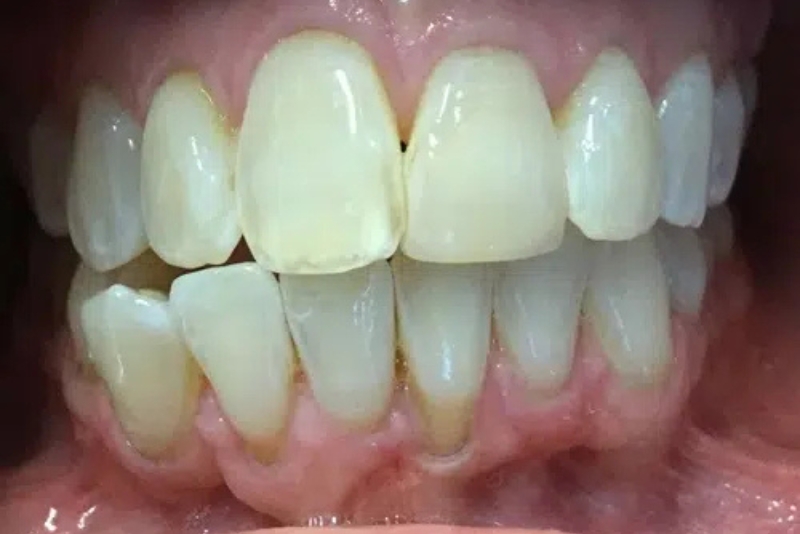 Clear Aligners - Before