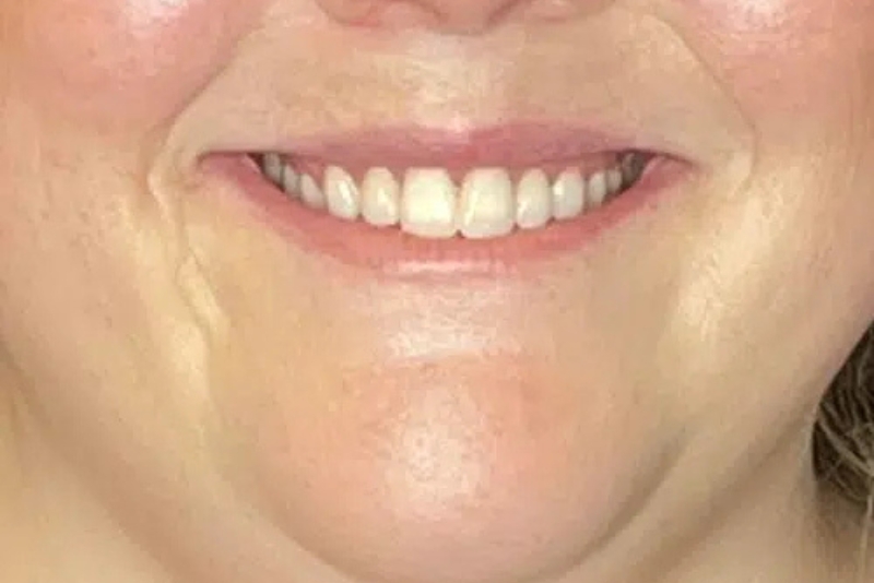 Botox - After