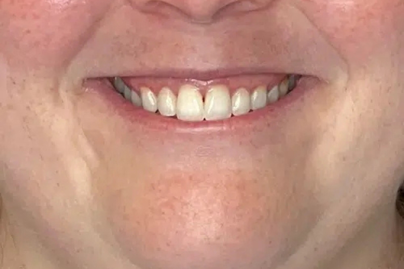 Botox - Before