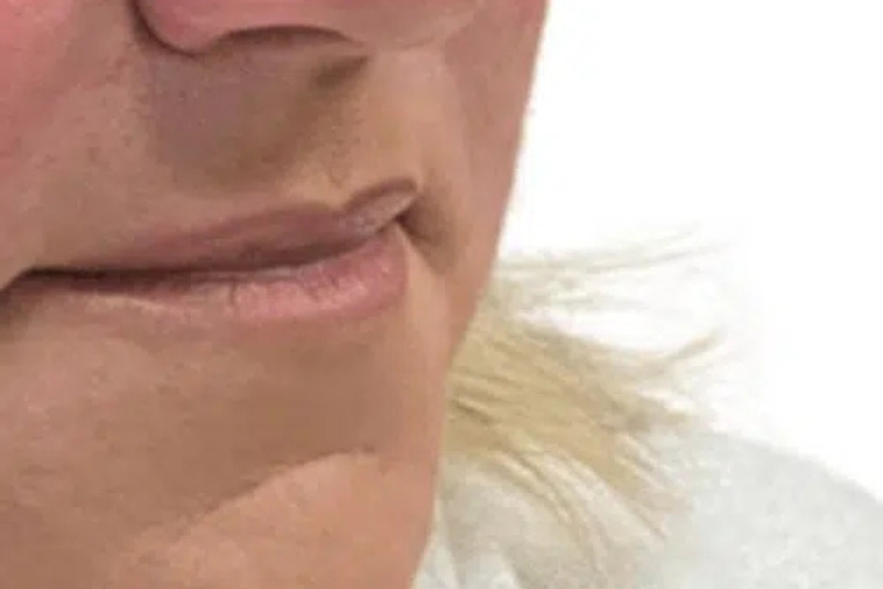 Dermal Fillers - After