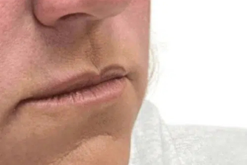 Dermal Fillers - Before
