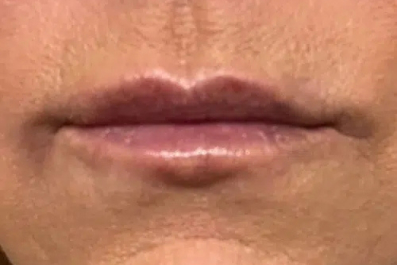 Dermal Fillers & Medical-Grade Skin Care - After