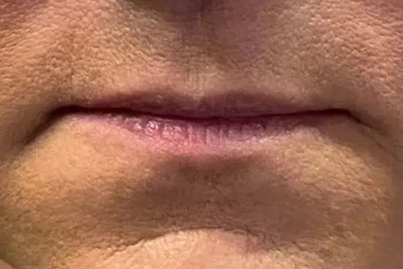 Dermal Fillers & Medical-Grade Skin Care - Before