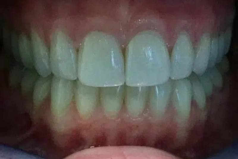 Teeth Whitening - After