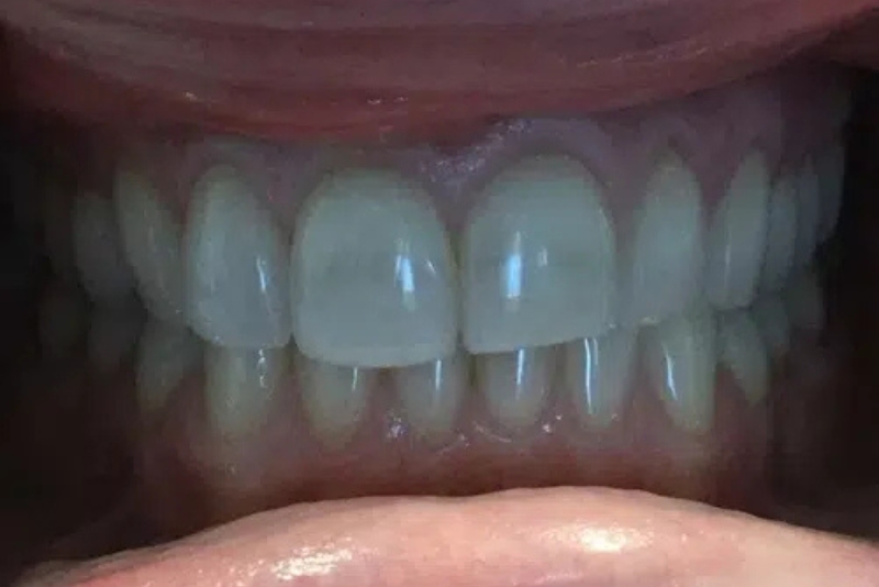 Teeth Whitening - Before