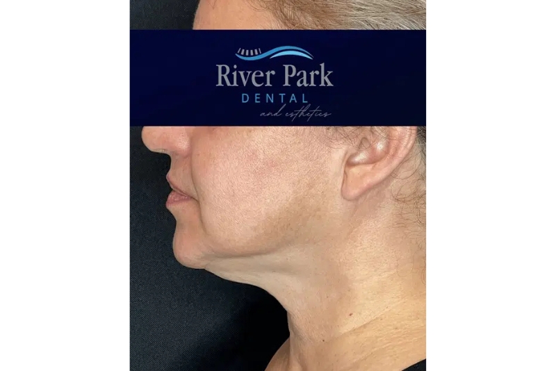 Laser Skin Tightening - After