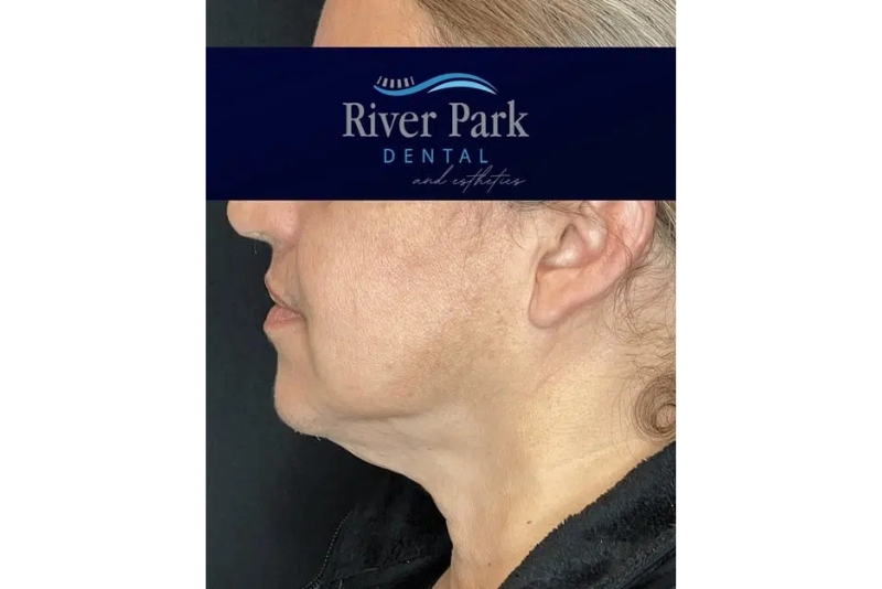 Laser Skin Tightening - Before