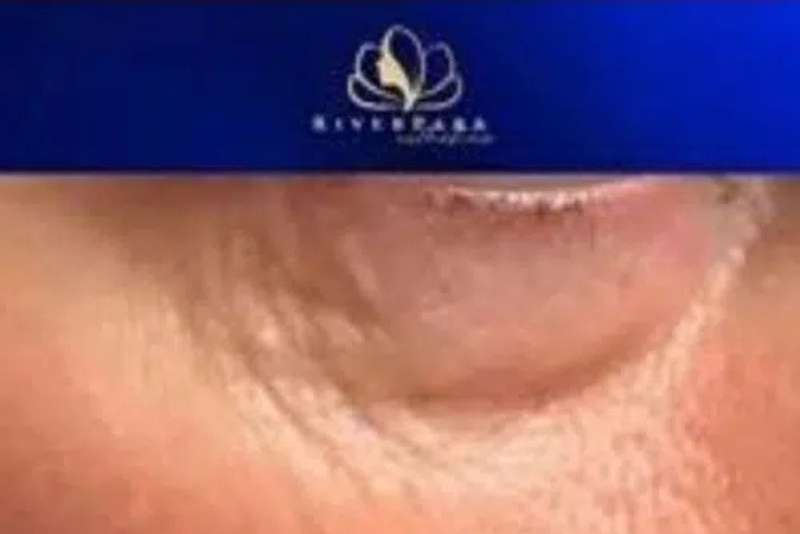 RF Skin Resurfacing & Tightening - After