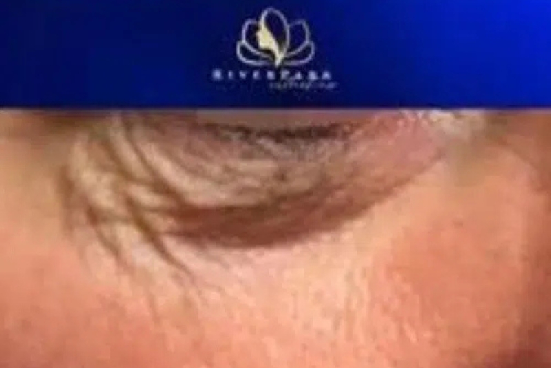 RF Skin Resurfacing & Tightening - Before