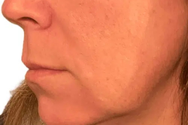 PDO Collagen Threads - Before