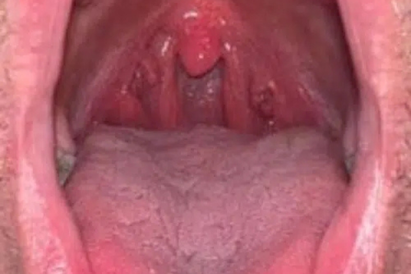 PBM Therapy - After