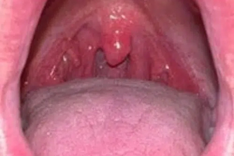 PBM Therapy - Before