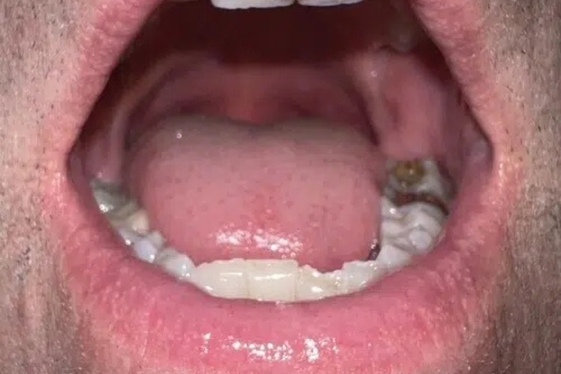 NightLase Snoring Therapy - After