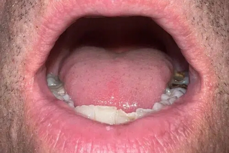NightLase Snoring Therapy - Before