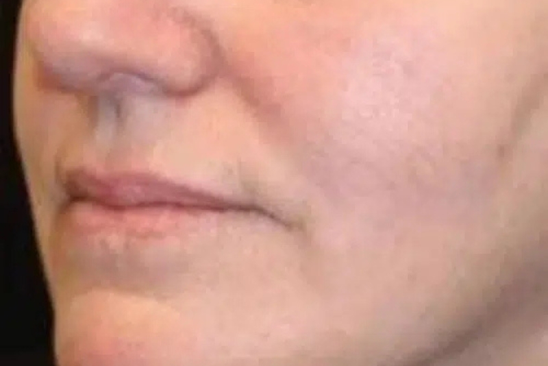RF Skin Resurfacing & Tightening - After