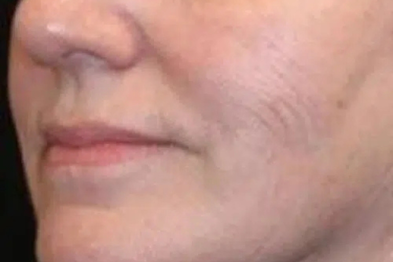 RF Skin Resurfacing & Tightening - Before
