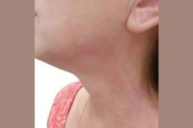RF Skin Tightening - After