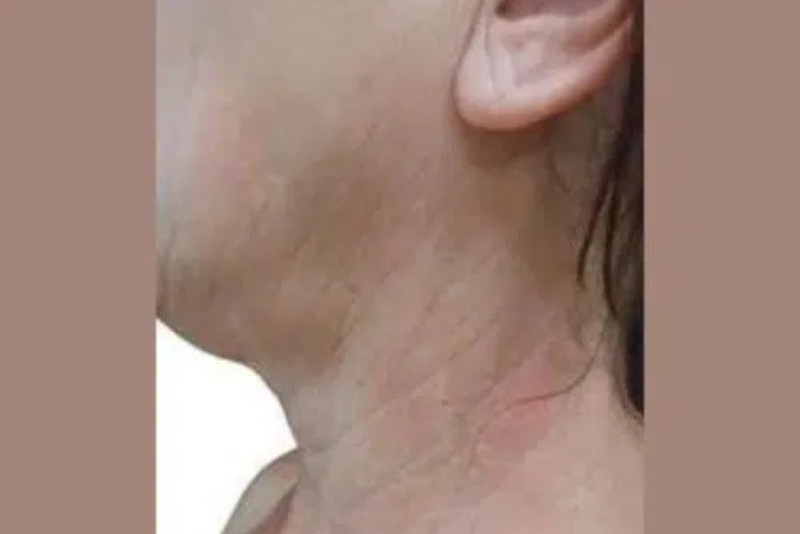 RF Skin Tightening - Before